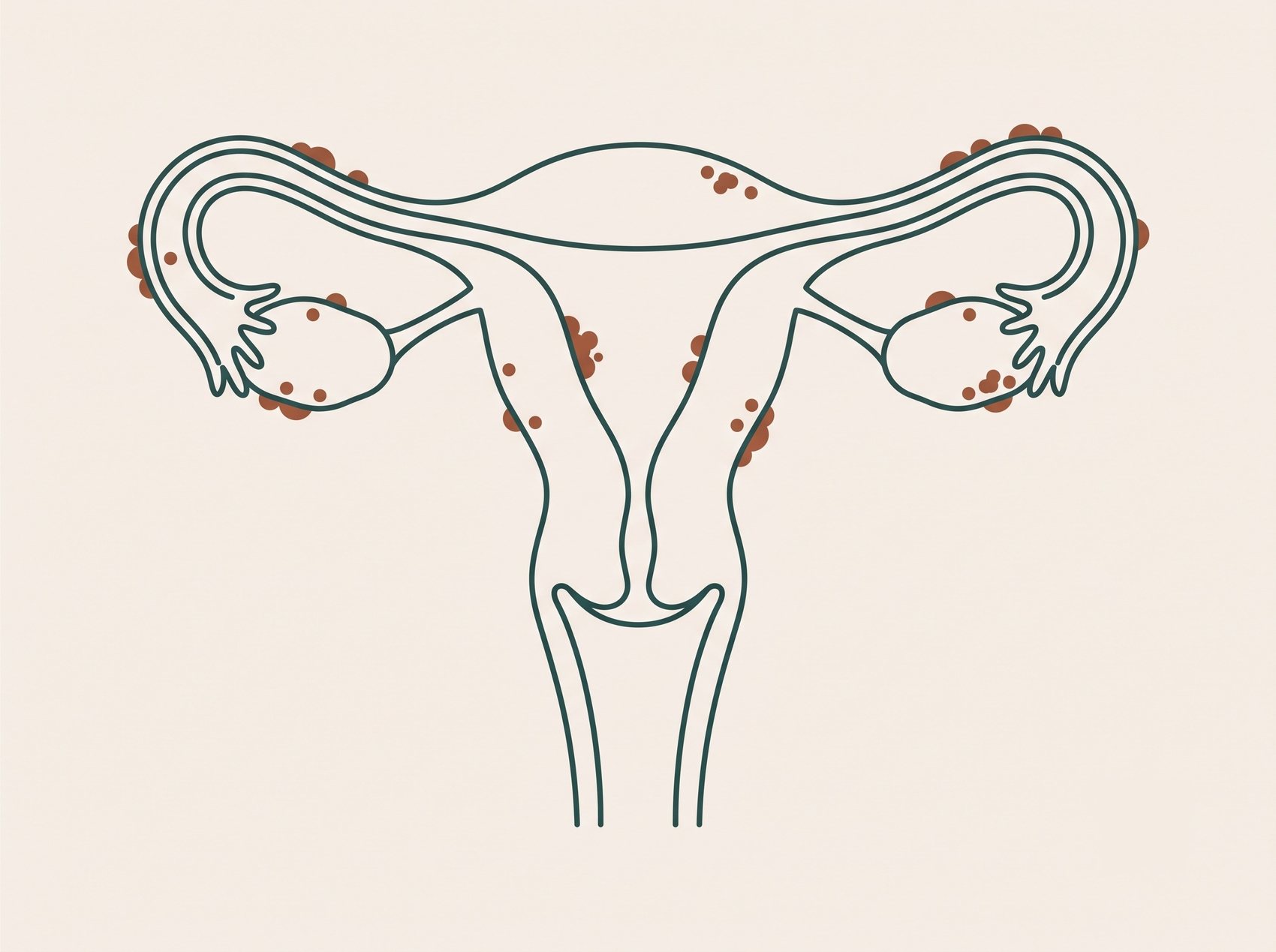 Esquema del aparato reproductor femenino con los focos de endometriosis en sus localizaciones más frecuentes.